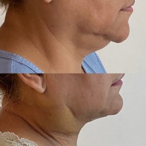 before-after photo deep-plane-facelift