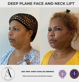 before-after photo deep-plane-facelift