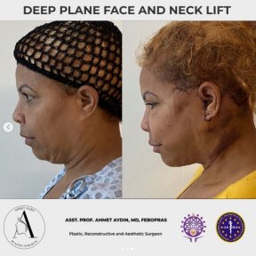 before-after photo deep-plane-facelift