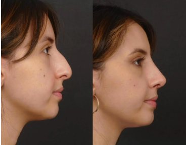 before-after photo rhinoplasty-nose-job