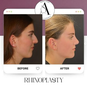 before-after photo rhinoplasty-nose-job