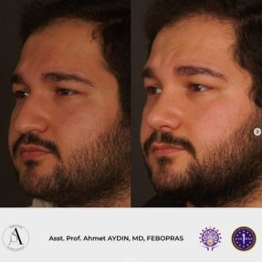 before-after photo rhinoplasty-nose-job