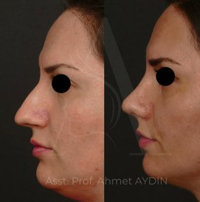 before-after photo rhinoplasty-nose-job