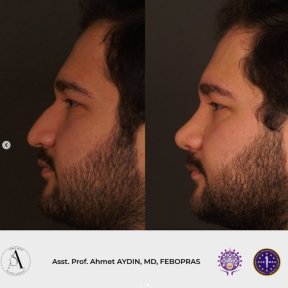 before-after photo rhinoplasty-nose-job