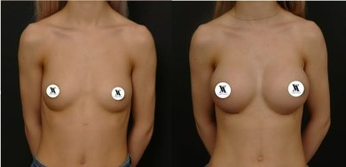 before-after photo breast-augmentation