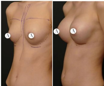 before-after photo breast-augmentation
