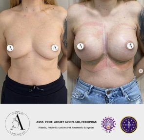 before-after photo breast-augmentation