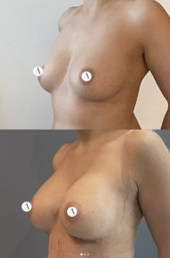 before-after photo breast-augmentation