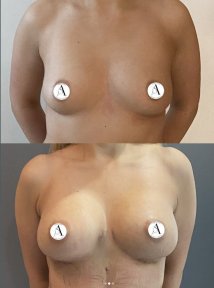 before-after photo breast-augmentation