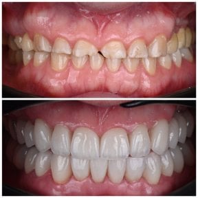 Before and after dental veneers at YAREMA DENTAL – smile makeover with natural-looking results