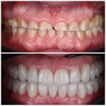 Before and after dental veneers at YAREMA DENTAL – smile makeover with natural-looking results