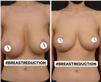 before-after photo mastopexy-breast-lift-contour-plastics