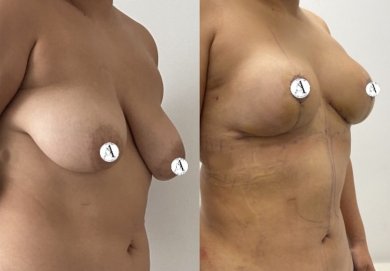 before-after photo mastopexy-breast-lift-contour-plastics