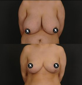 before-after photo mastopexy-breast-lift-contour-plastics