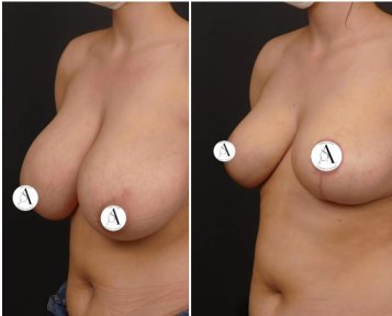 before-after photo mastopexy-breast-lift-contour-plastics