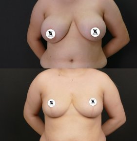 before-after photo mastopexy-breast-lift-contour-plastics