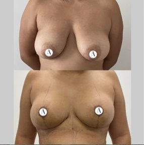 before-after photo mastopexy-breast-lift-contour-plastics