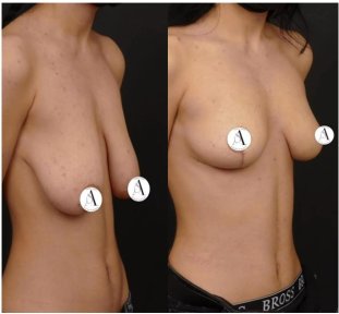 before-after photo mastopexy-breast-lift-contour-plastics