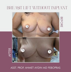 before-after photo mastopexy-breast-lift-contour-plastics