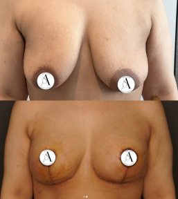 before-after photo mastopexy-breast-lift-contour-plastics