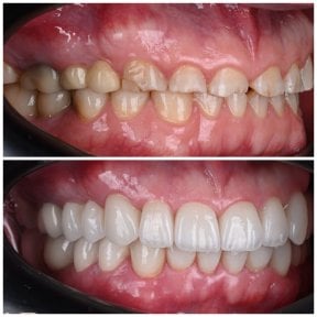 Before and after veneers at YAREMA DENTAL – smile transformation with natural-looking results