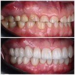 Before and after veneers at YAREMA DENTAL – smile transformation with natural-looking results