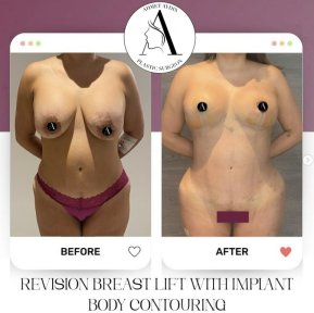 before-after photo breast-implants-with-breast-lift