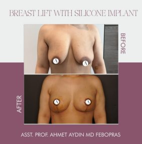 before-after photo breast-implants-with-breast-lift