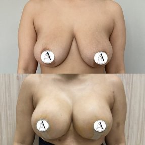 before-after photo breast-implants-with-breast-lift