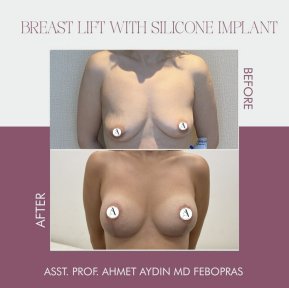 before-after photo breast-implants-with-breast-lift