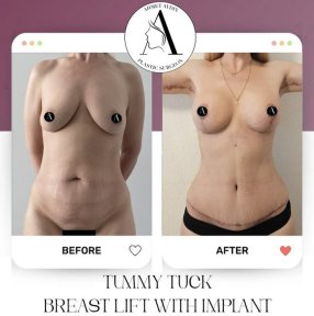 before-after photo mommy-makeover
