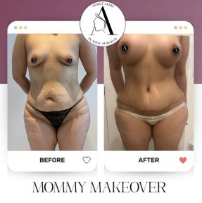 before-after photo mommy-makeover