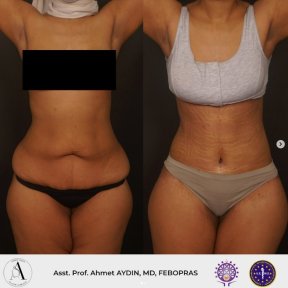 before-after photo mommy-makeover
