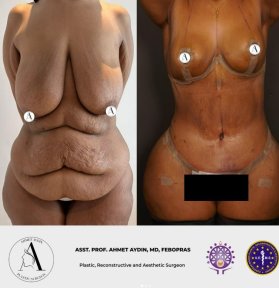 before-after photo mommy-makeover