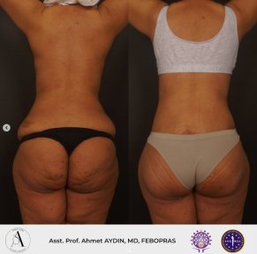 before-after photo mommy-makeover