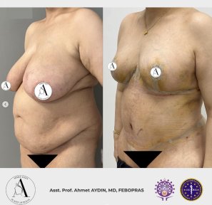 before-after photo mommy-makeover
