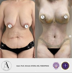 before-after photo mommy-makeover