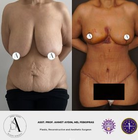 before-after photo mommy-makeover