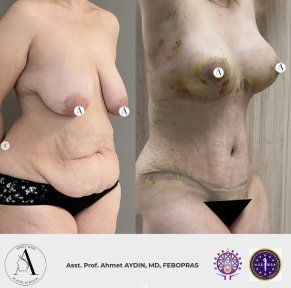 before-after photo mommy-makeover