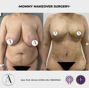 before-after photo mommy-makeover