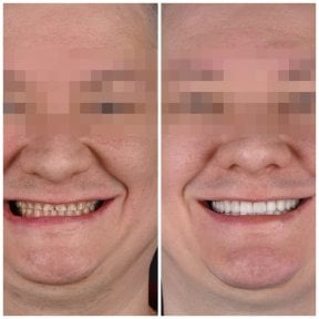 Before and after veneers at YAREMA DENTAL – smile transformation with natural-looking results