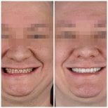 Before and after veneers at YAREMA DENTAL – smile transformation with natural-looking results