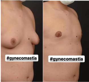 before-after photo gynecomastia-surgery