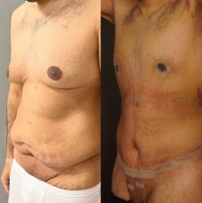 before-after photo gynecomastia-surgery