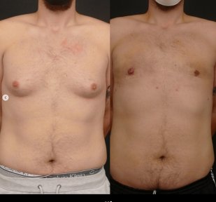 before-after photo gynecomastia-surgery