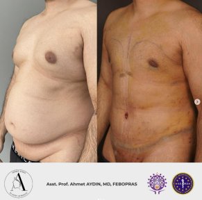 before-after photo gynecomastia-surgery