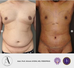 before-after photo gynecomastia-surgery