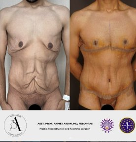 before-after photo post-bariatric-plastic-surgery