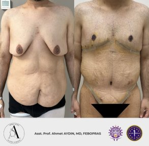 before-after photo post-bariatric-plastic-surgery