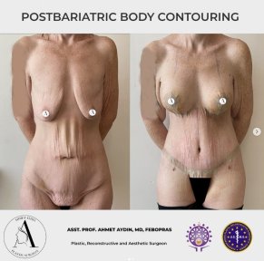 before-after photo post-bariatric-plastic-surgery